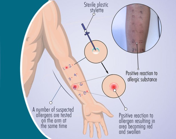 skin-prick-test-illustration-1160-px-v3
