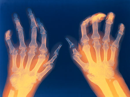rheumatoid-arthritis-hands.jpg
