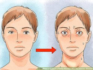 aid1353020-v4-728px-Support-a-Family-Member-Who-Has-Graves'-Disease-Step-1-Version-2